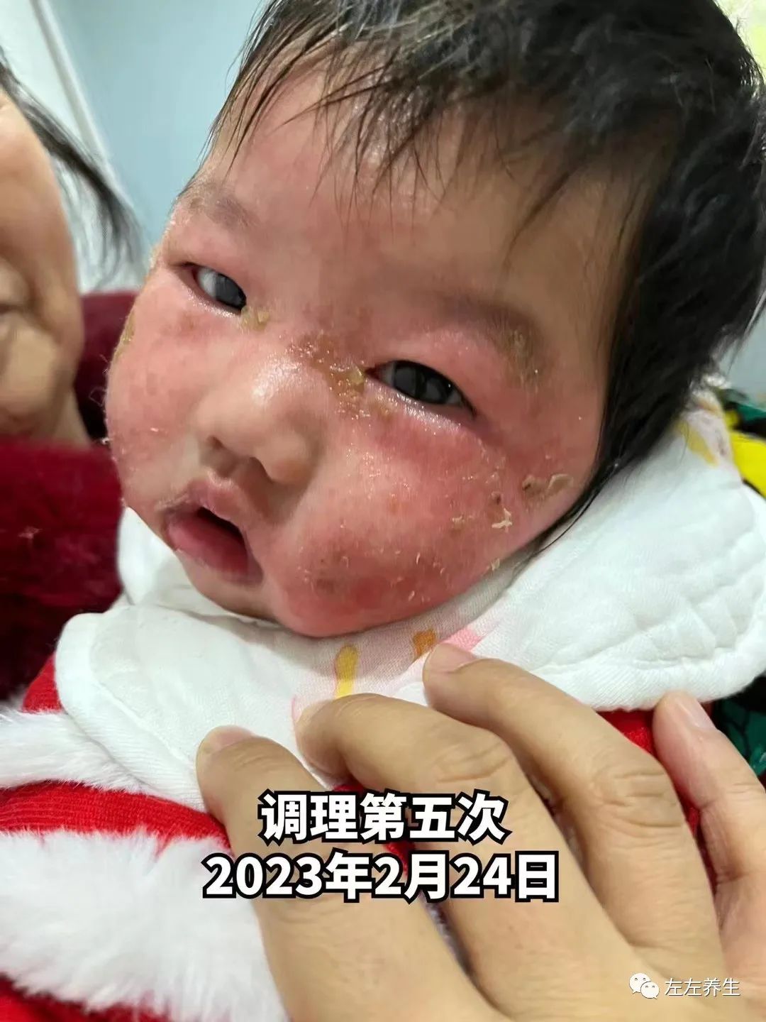 3个月婴儿脸上严重湿疹调理案例 3个月婴儿脸上严重湿疹调理案例