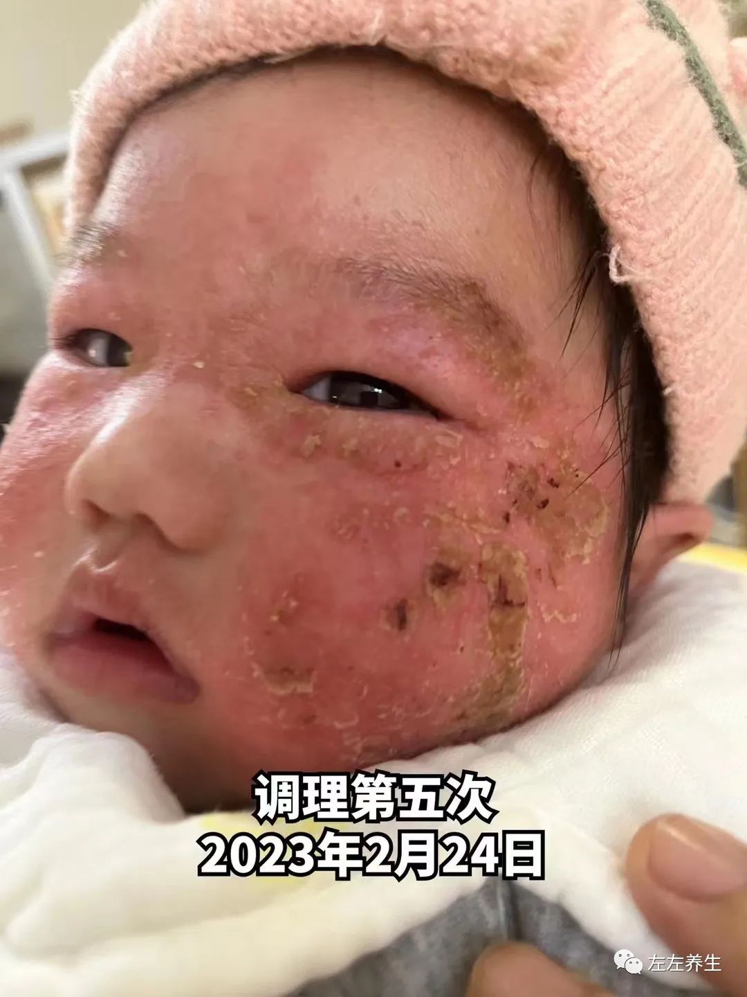 3个月婴儿脸上严重湿疹调理案例 3个月婴儿脸上严重湿疹调理案例