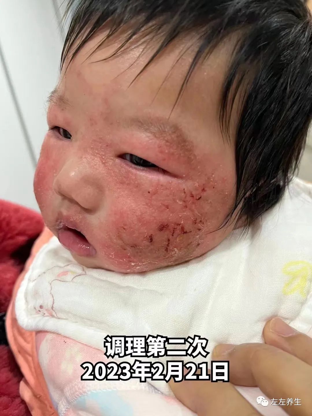 3个月婴儿脸上严重湿疹调理案例 3个月婴儿脸上严重湿疹调理案例