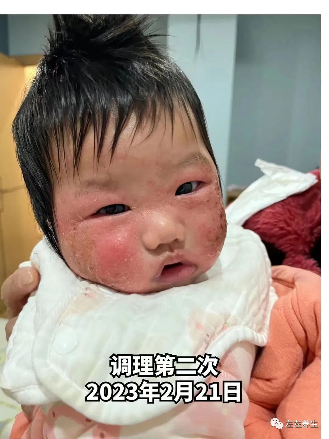 3个月婴儿脸上严重湿疹调理案例 3个月婴儿脸上严重湿疹调理案例