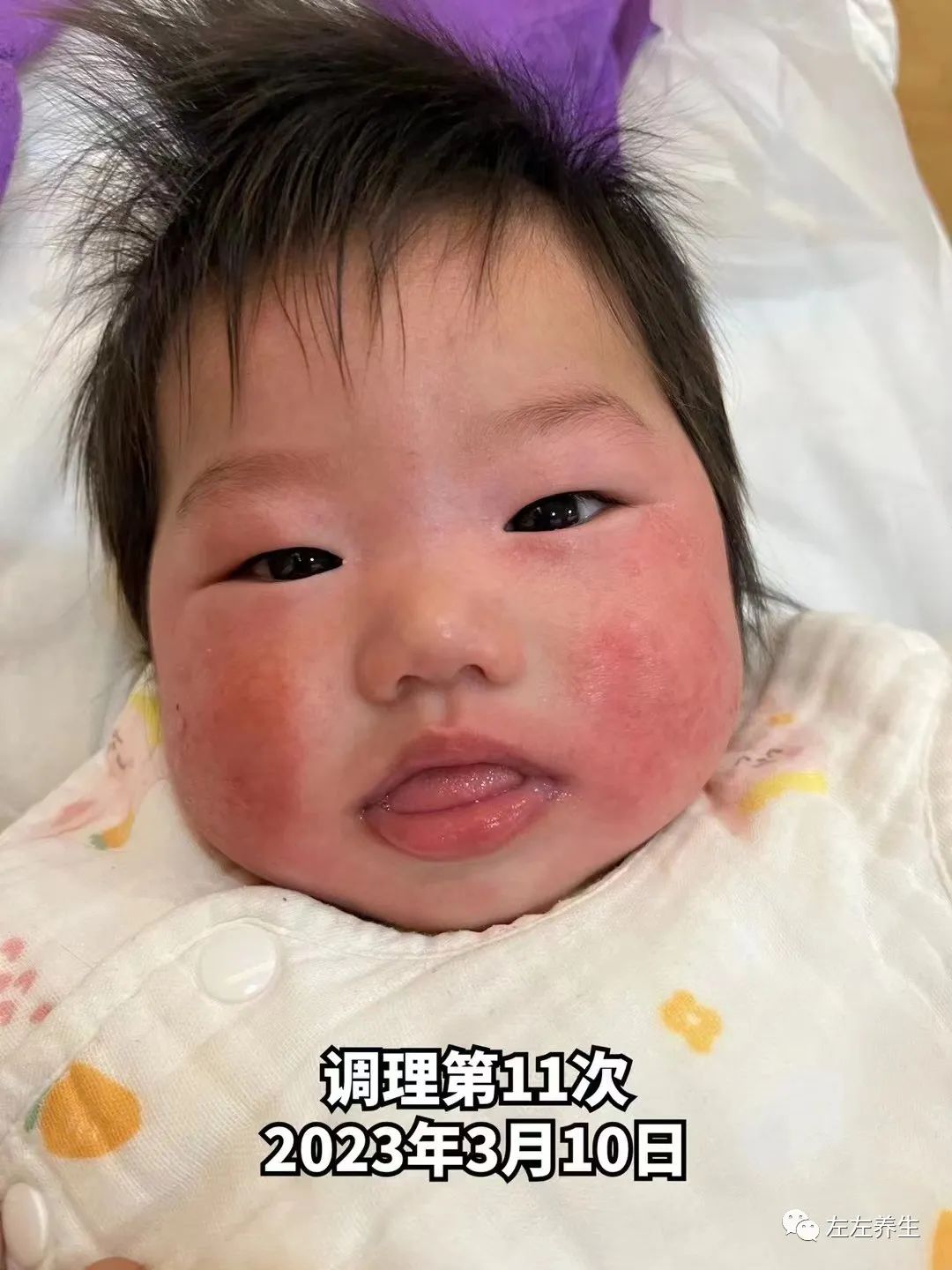 3个月婴儿脸上严重湿疹调理案例 3个月婴儿脸上严重湿疹调理案例