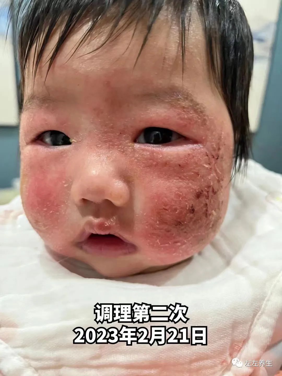 3个月婴儿脸上严重湿疹调理案例 3个月婴儿脸上严重湿疹调理案例