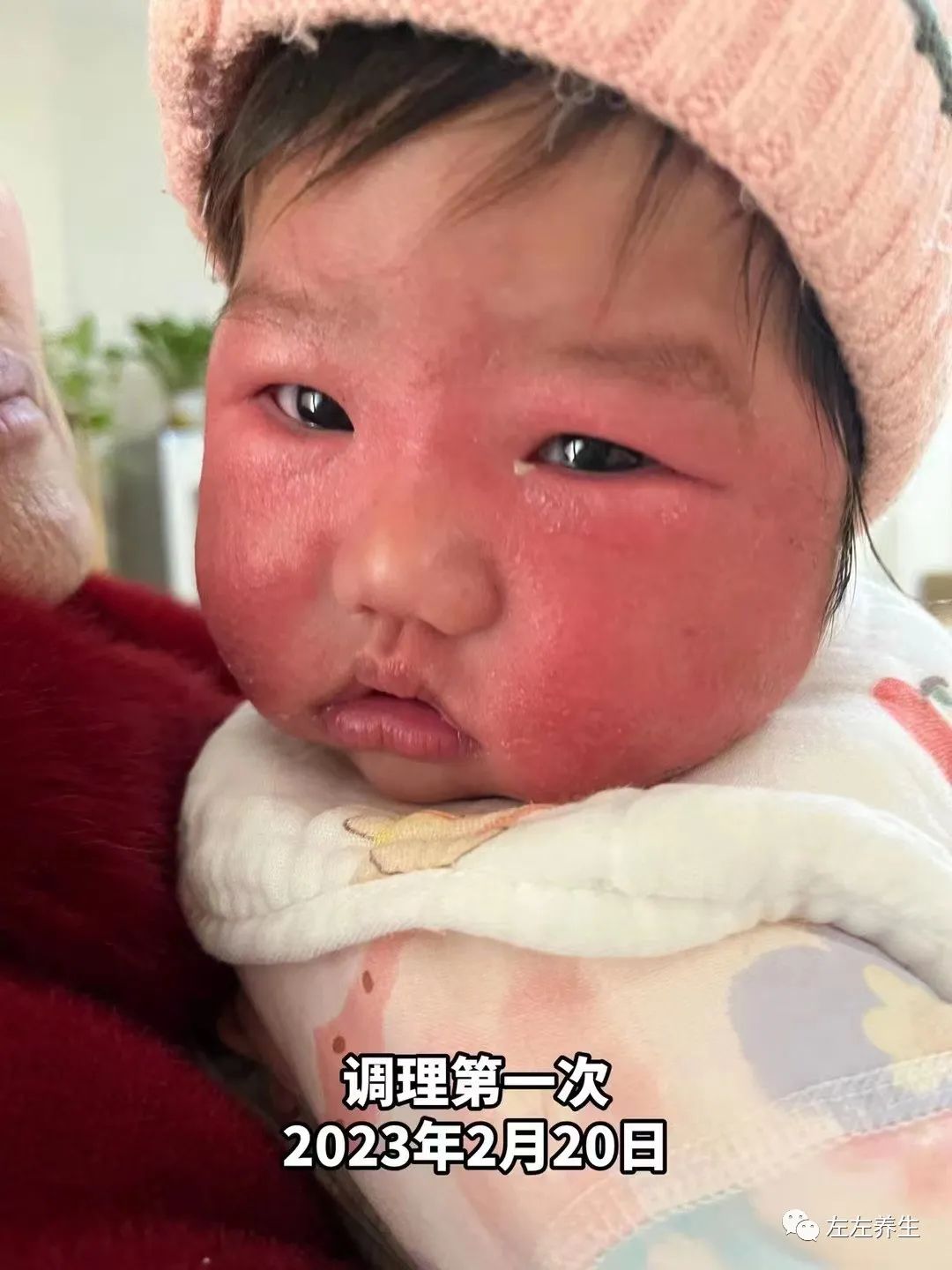 3个月婴儿脸上严重湿疹调理案例 3个月婴儿脸上严重湿疹调理案例