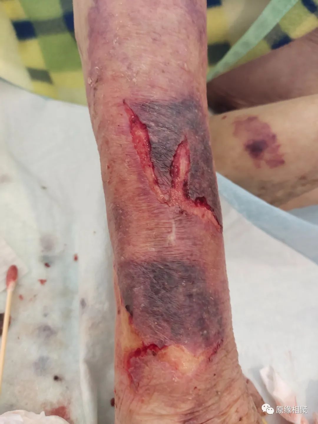 胳膊摔伤 胳膊摔伤