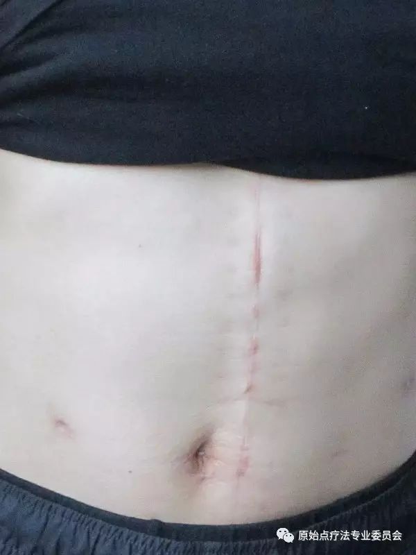 原始点疗法给我带来的生命奇迹——周善舟老师的原始点康复历程