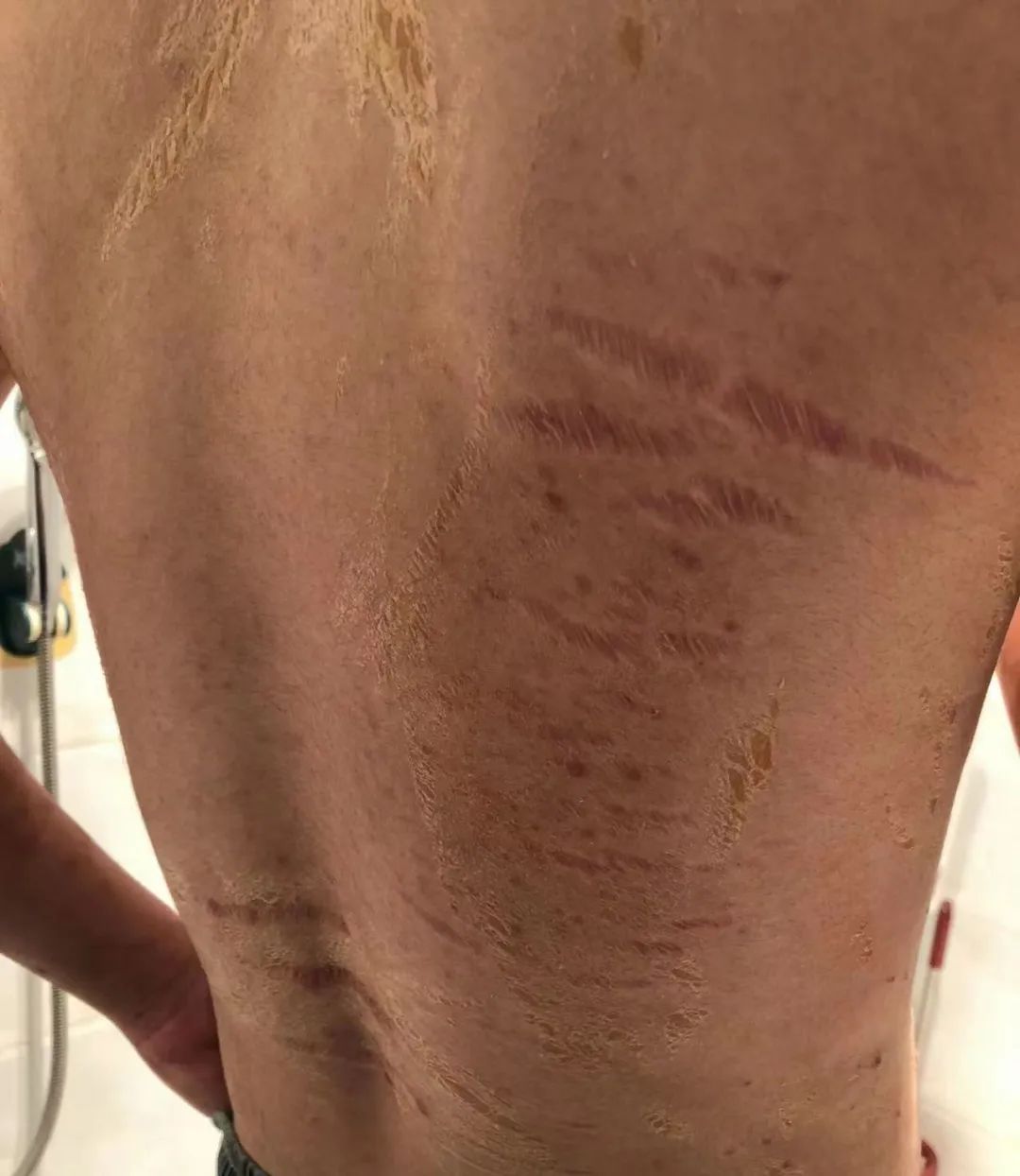 案例分享:牛皮癣,75天好转90%以上 案例分享:牛皮癣,75天好转90%以上