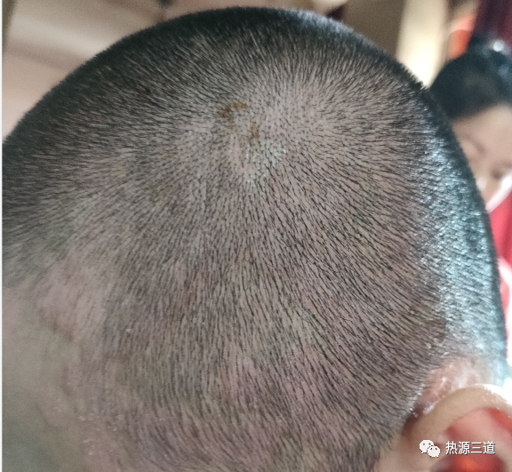 案例分享:牛皮癣,75天好转90%以上 案例分享:牛皮癣,75天好转90%以上