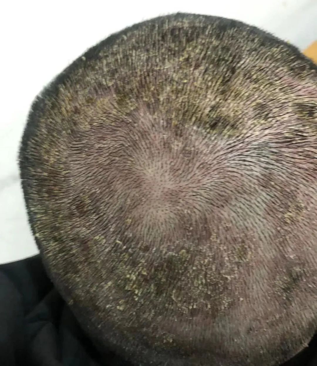 案例分享:牛皮癣,75天好转90%以上 案例分享:牛皮癣,75天好转90%以上