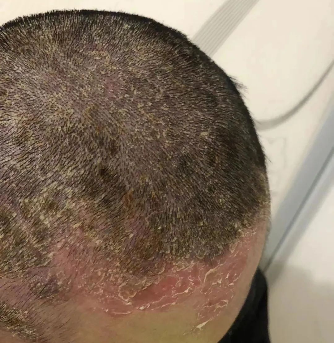 案例分享:牛皮癣,75天好转90%以上 案例分享:牛皮癣,75天好转90%以上