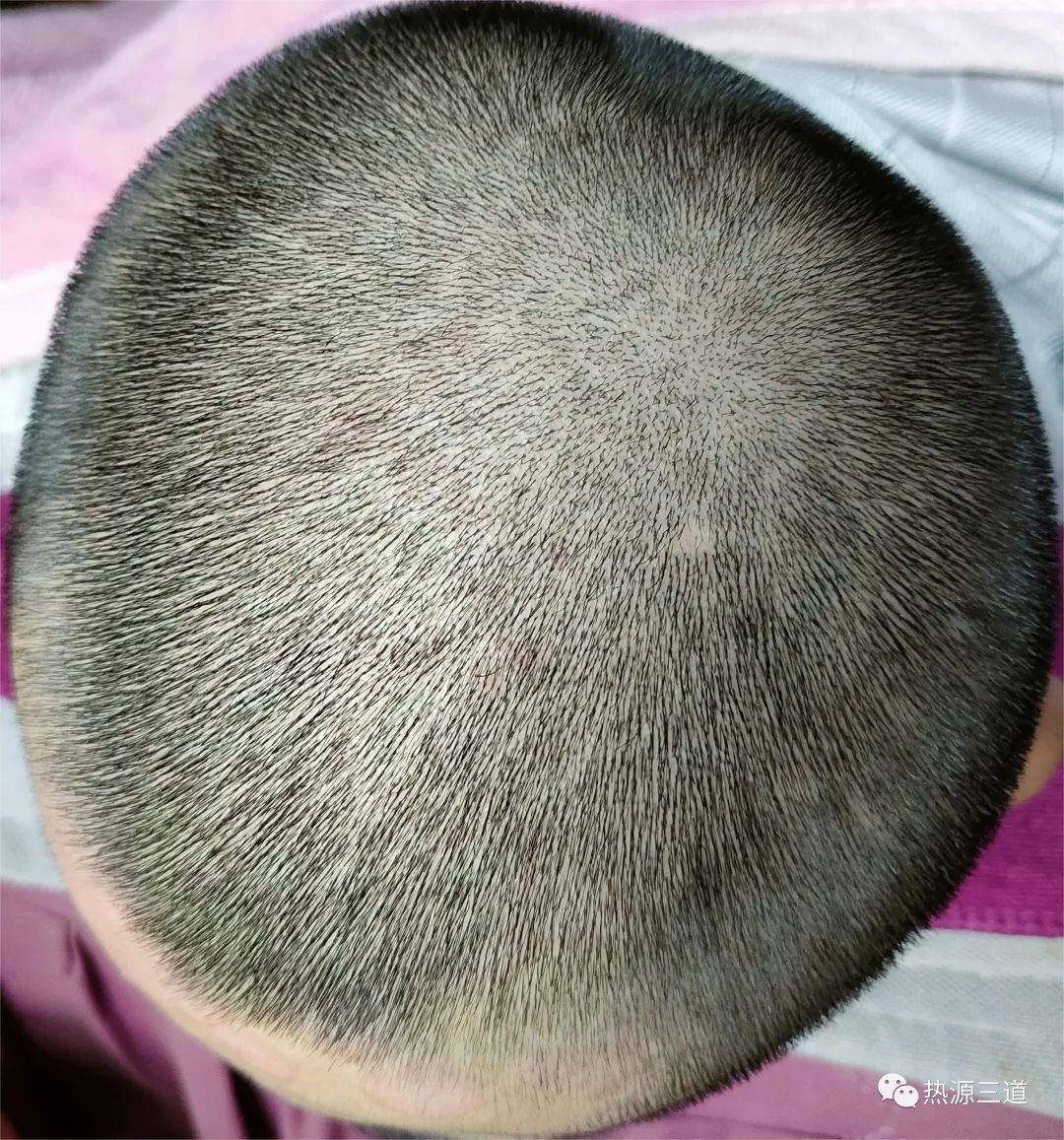 案例分享:牛皮癣,75天好转90%以上 案例分享:牛皮癣,75天好转90%以上