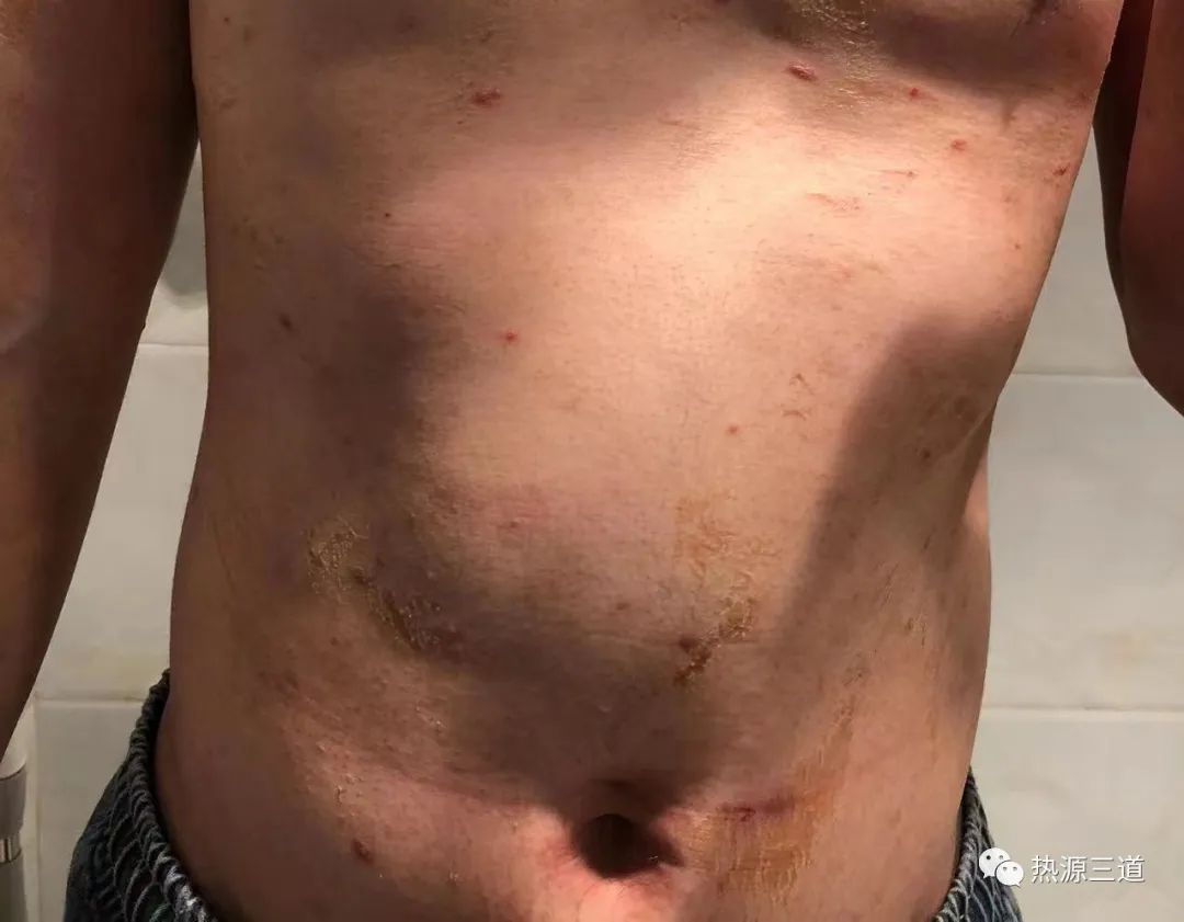 案例分享:牛皮癣,75天好转90%以上 案例分享:牛皮癣,75天好转90%以上