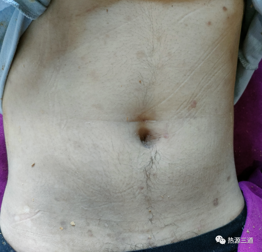 案例分享:牛皮癣,75天好转90%以上 案例分享:牛皮癣,75天好转90%以上