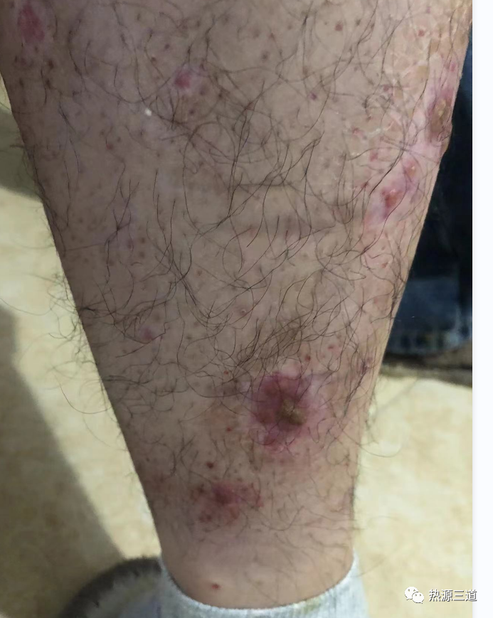 案例分享:牛皮癣,75天好转90%以上 案例分享:牛皮癣,75天好转90%以上