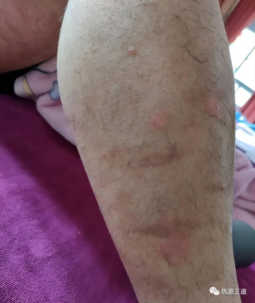 案例分享:牛皮癣,75天好转90%以上 案例分享:牛皮癣,75天好转90%以上