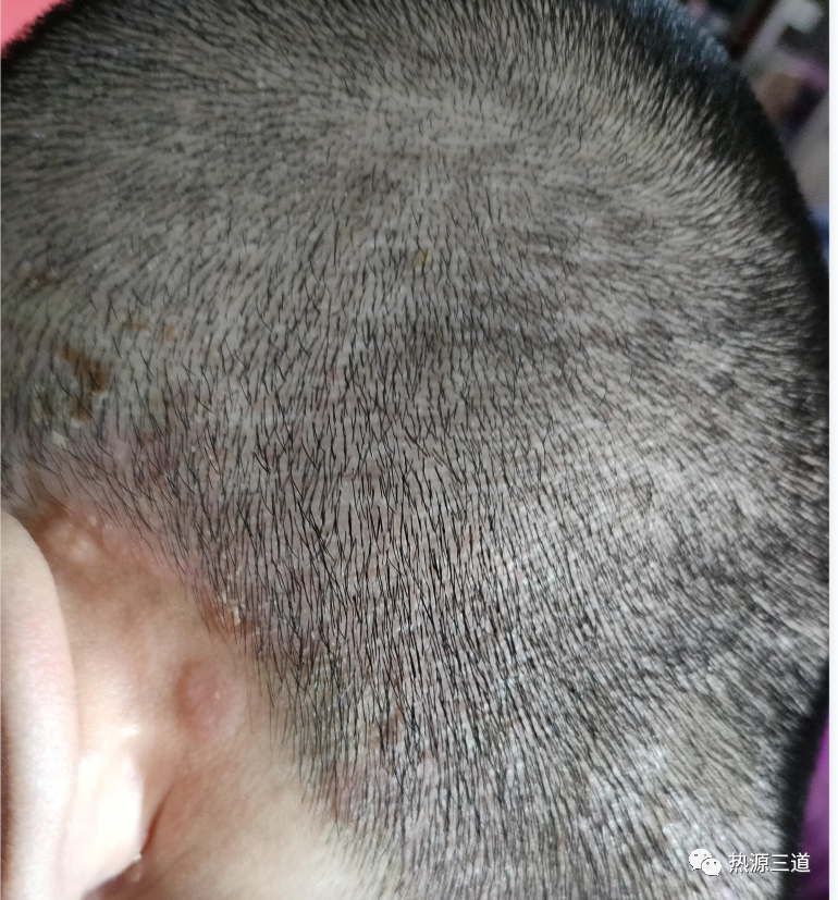 案例分享:牛皮癣,75天好转90%以上 案例分享:牛皮癣,75天好转90%以上