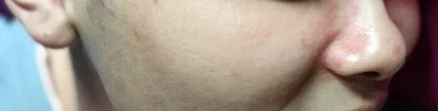 案例分享:牛皮癣,75天好转90%以上 案例分享:牛皮癣,75天好转90%以上