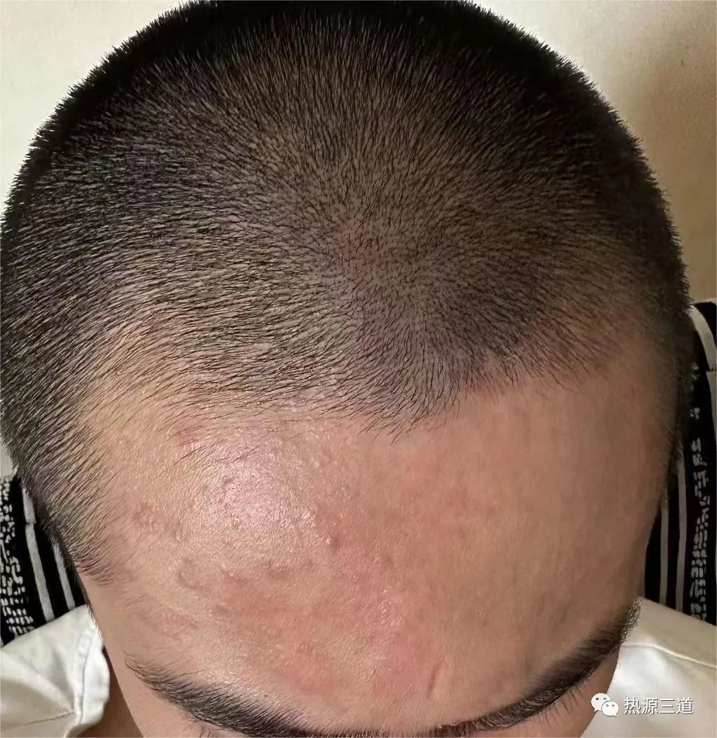 案例分享:牛皮癣,75天好转90%以上 案例分享:牛皮癣,75天好转90%以上