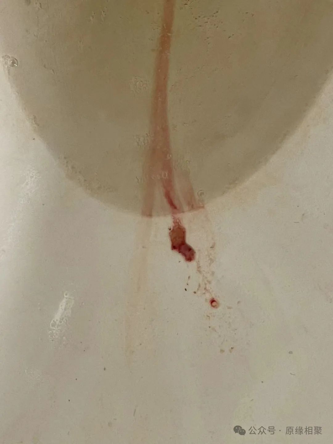 膀胱恶性肿瘤 膀胱恶性肿瘤