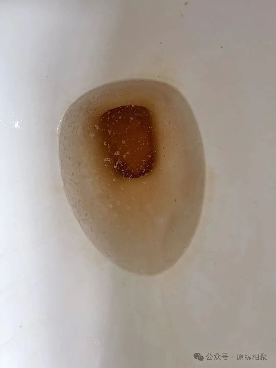 膀胱恶性肿瘤 膀胱恶性肿瘤