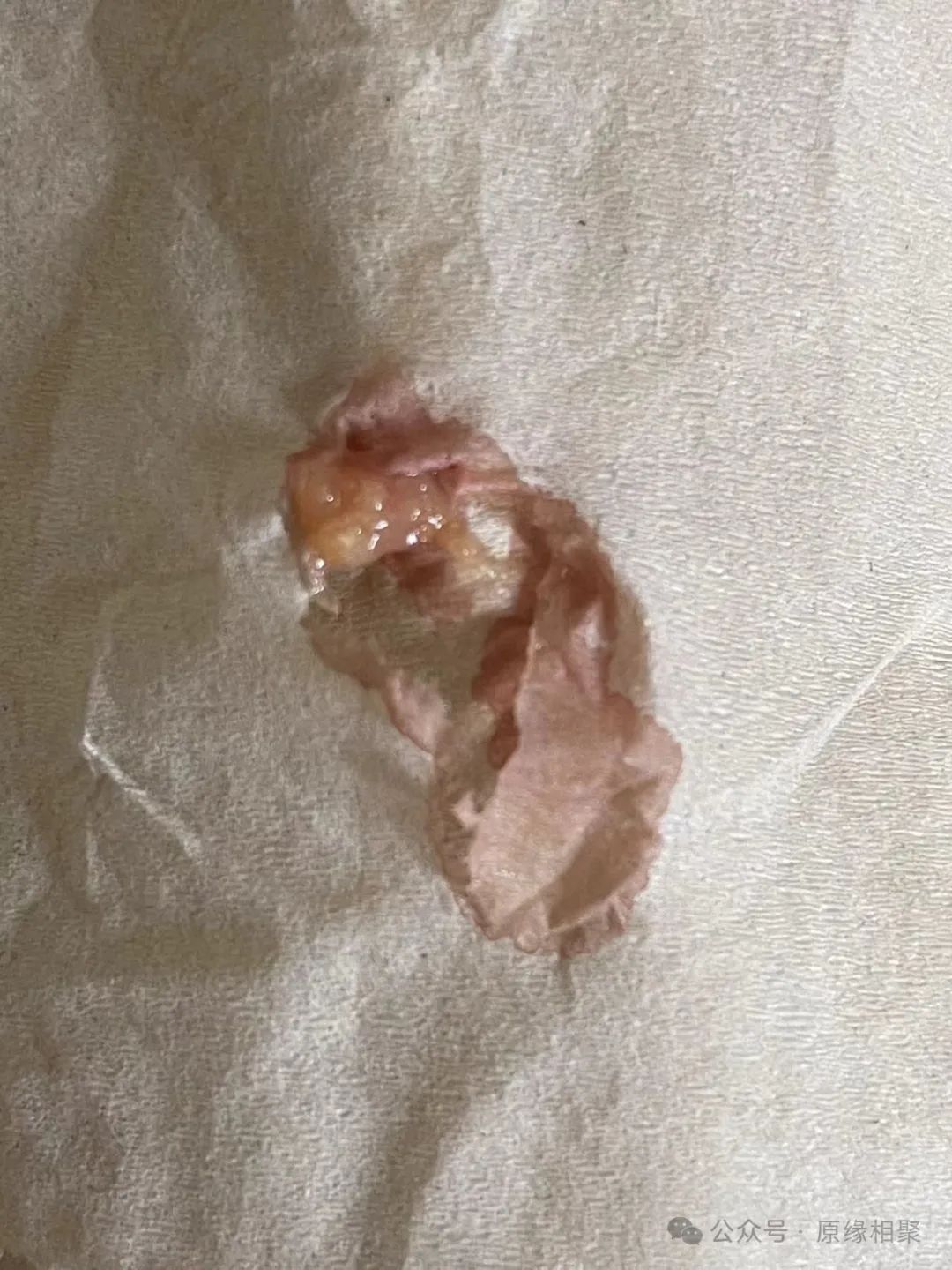 膀胱恶性肿瘤 膀胱恶性肿瘤