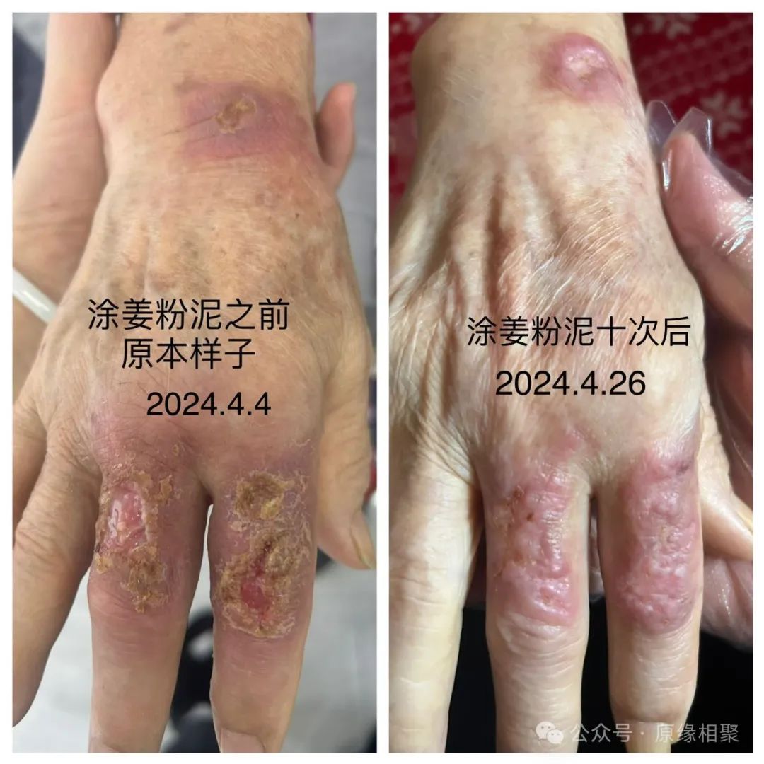 手部溃烂不愈合