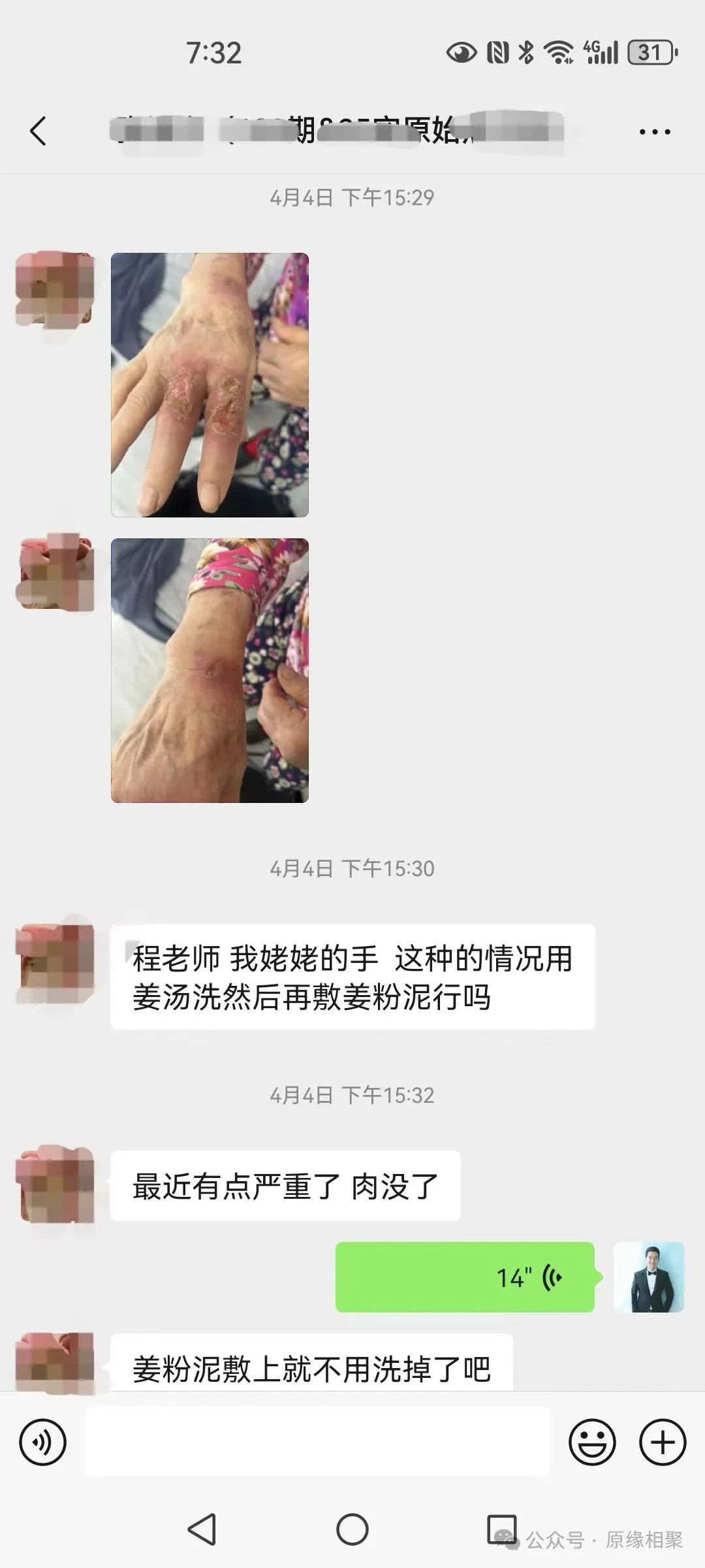 手部溃烂不愈合 手部溃烂不愈合