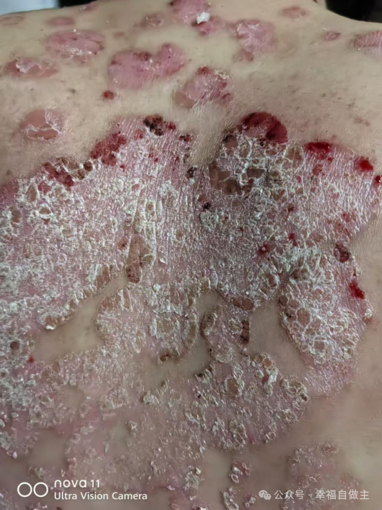 牛皮癣案例 牛皮癣案例