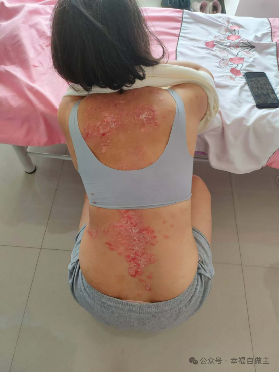 牛皮癣案例 牛皮癣案例