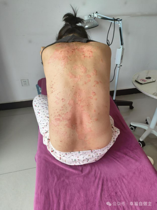 牛皮癣案例 牛皮癣案例