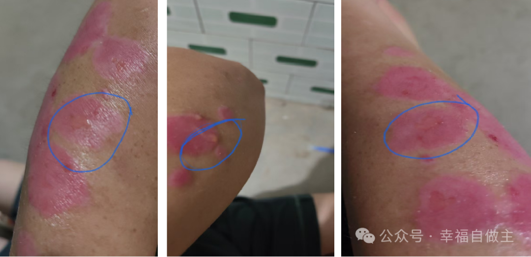 牛皮癣案例 牛皮癣案例