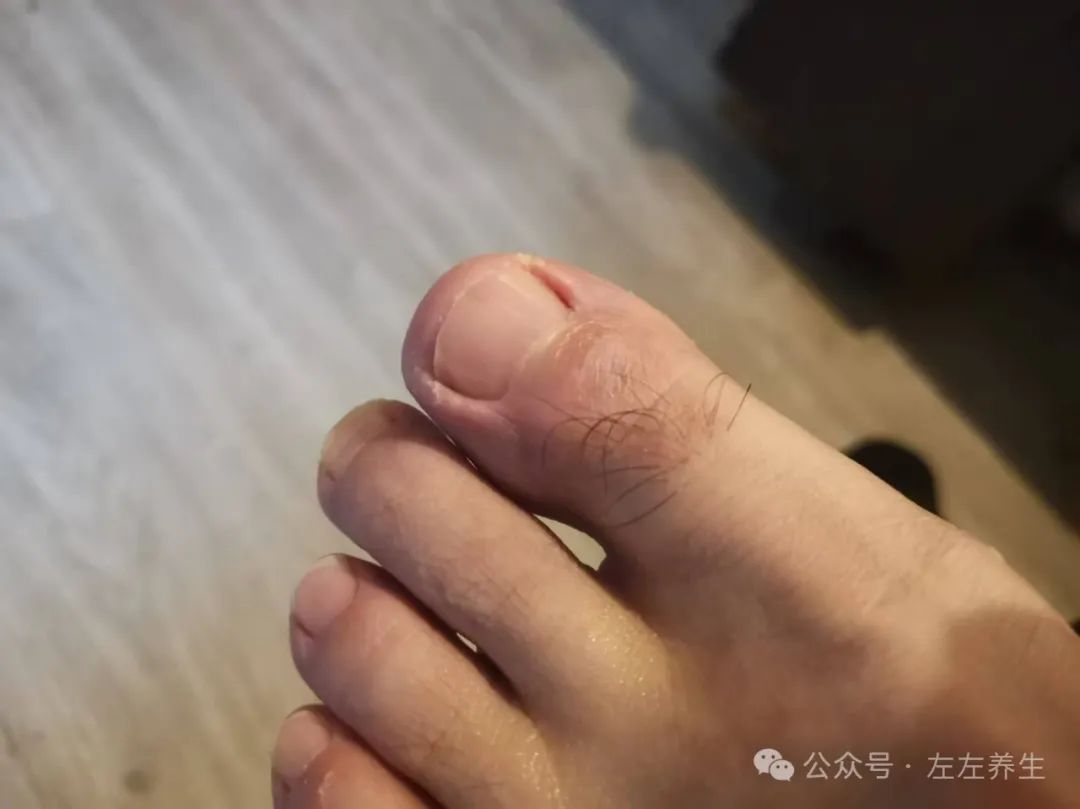 案例分享:原始点调理烫伤案例 案例分享:原始点调理烫伤案例