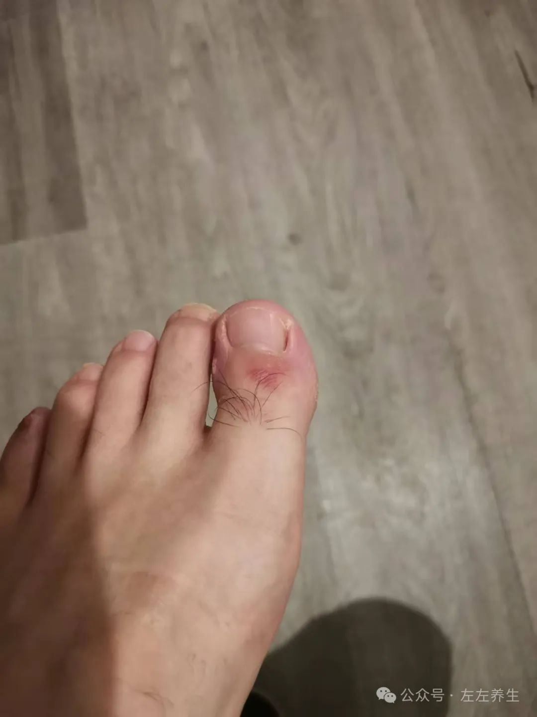 案例分享:原始点调理烫伤案例 案例分享:原始点调理烫伤案例