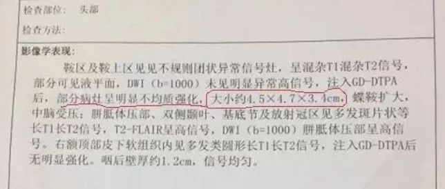 原始点案例|脑瘤-原始点全球同学网