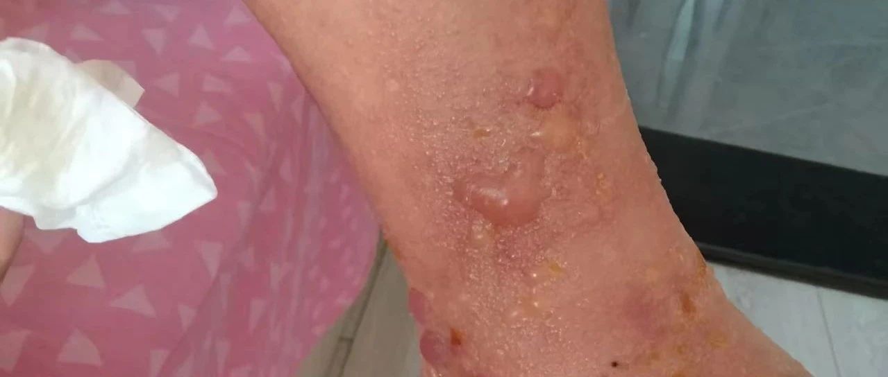 脚踝部疱疹-原始点全球同学网