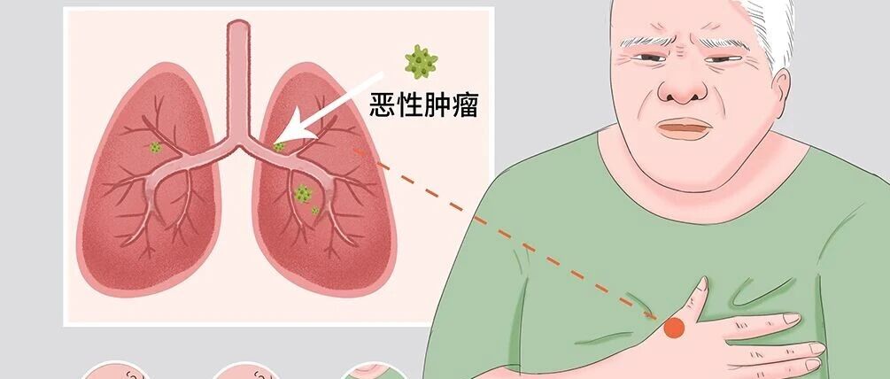 YSD让她重获新生---肺癌康复案例-原始点全球同学网