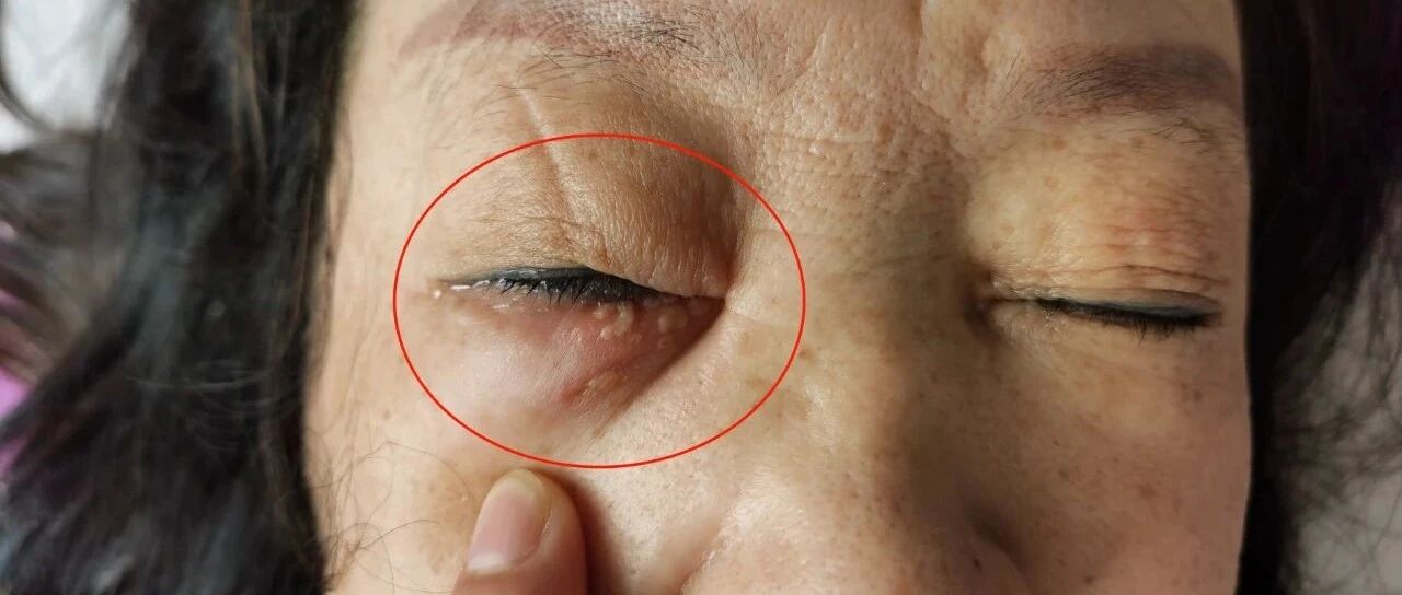 眼部带状疱疹-原始点全球同学网